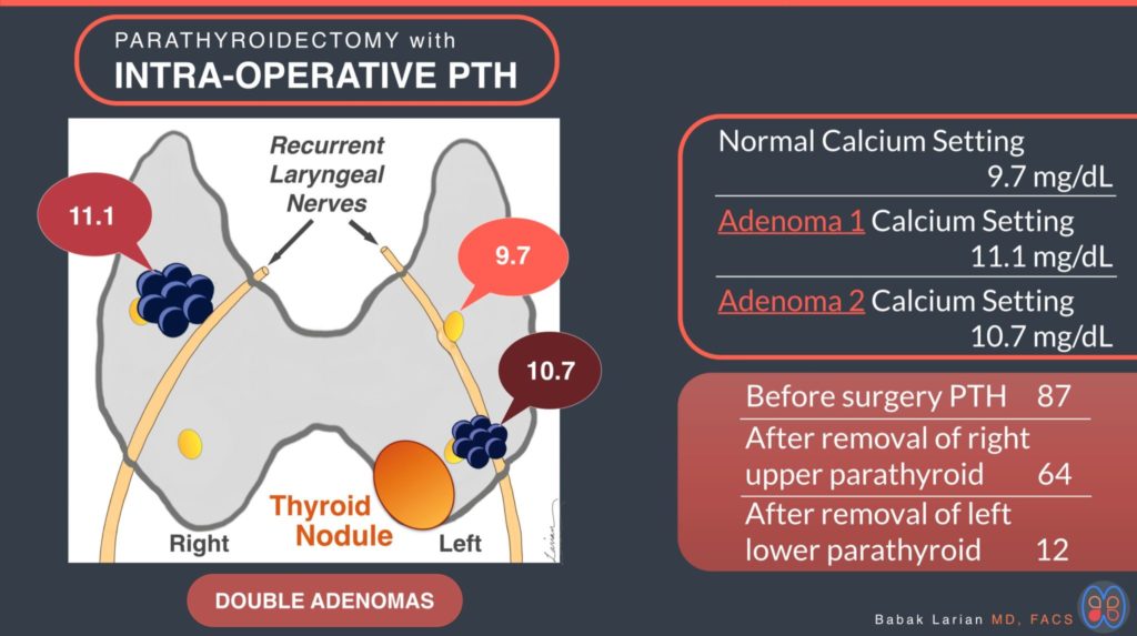 Parathyroidectomy with intra-operative PTH double adenomas