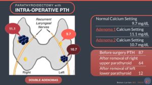 Parathyroidectomy with intra-operative PTH with double adenomas calcium setting