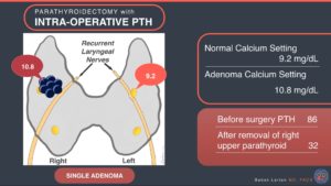 Parathyroidectomy with intra-operative PTH single adenoma