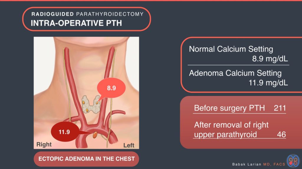 Radioguided parathyroidectomy intra-operative PTH Ectopic adenoma in the chest