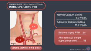 Radioguided parathyroidectomy intra-operative PTH Ectopic adenoma in the chest