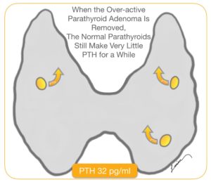 over active parathyroid adenoma is removed and normal parathyroids still make very little PTH