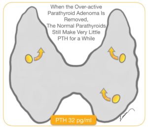 Illustration of a parathyroid gland post-adenoma removal, showing low PTH production from normal parathyroids.