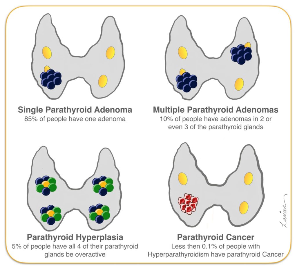 parathyroid adenoma, hyperplasia, and cancer