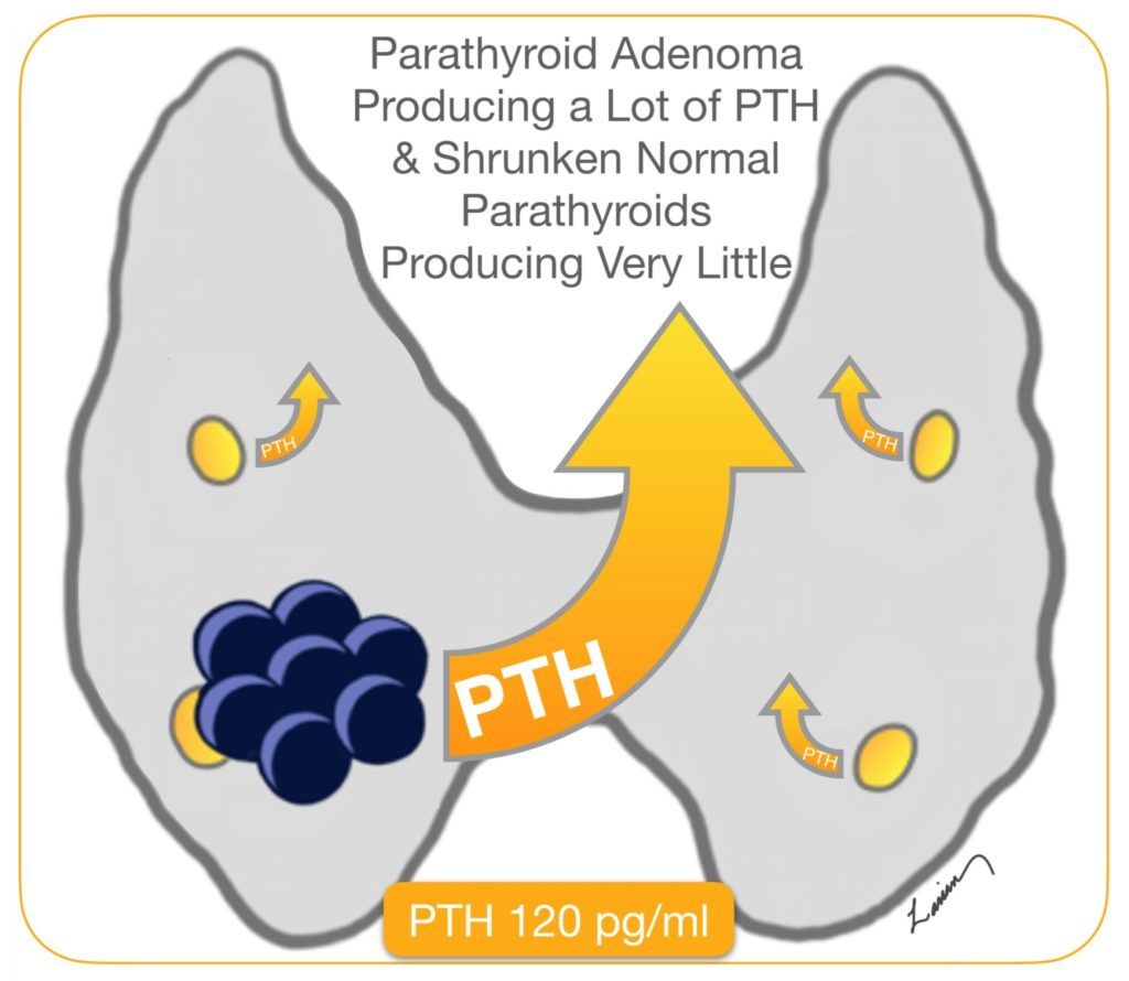 parathyroid adenoma producing a lot of PTH & shrunken normal parathyroids producing very llittle PTH