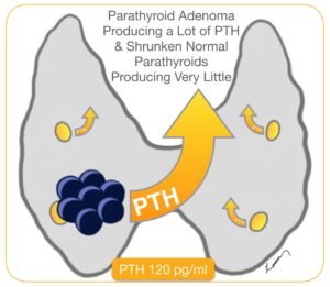 parathyroid adenoma producing a lot of PTH & shrunken normal parathyroids producing very llittle PTH