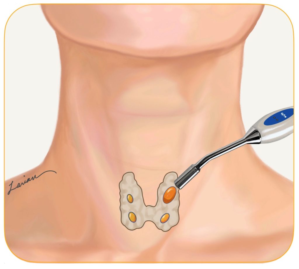 radioguided parathyroid surgery