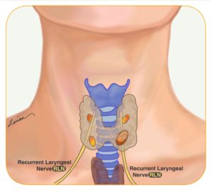 recurrent laryngeal nerve RLN