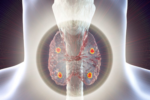 parathyroid glands hyperparathyroidism cured osteoclasto