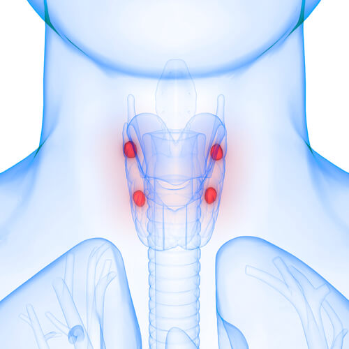 Bones, Moans, Groans, and Stones: Why Hyperparathyroidism Is Often Misdiagnosed