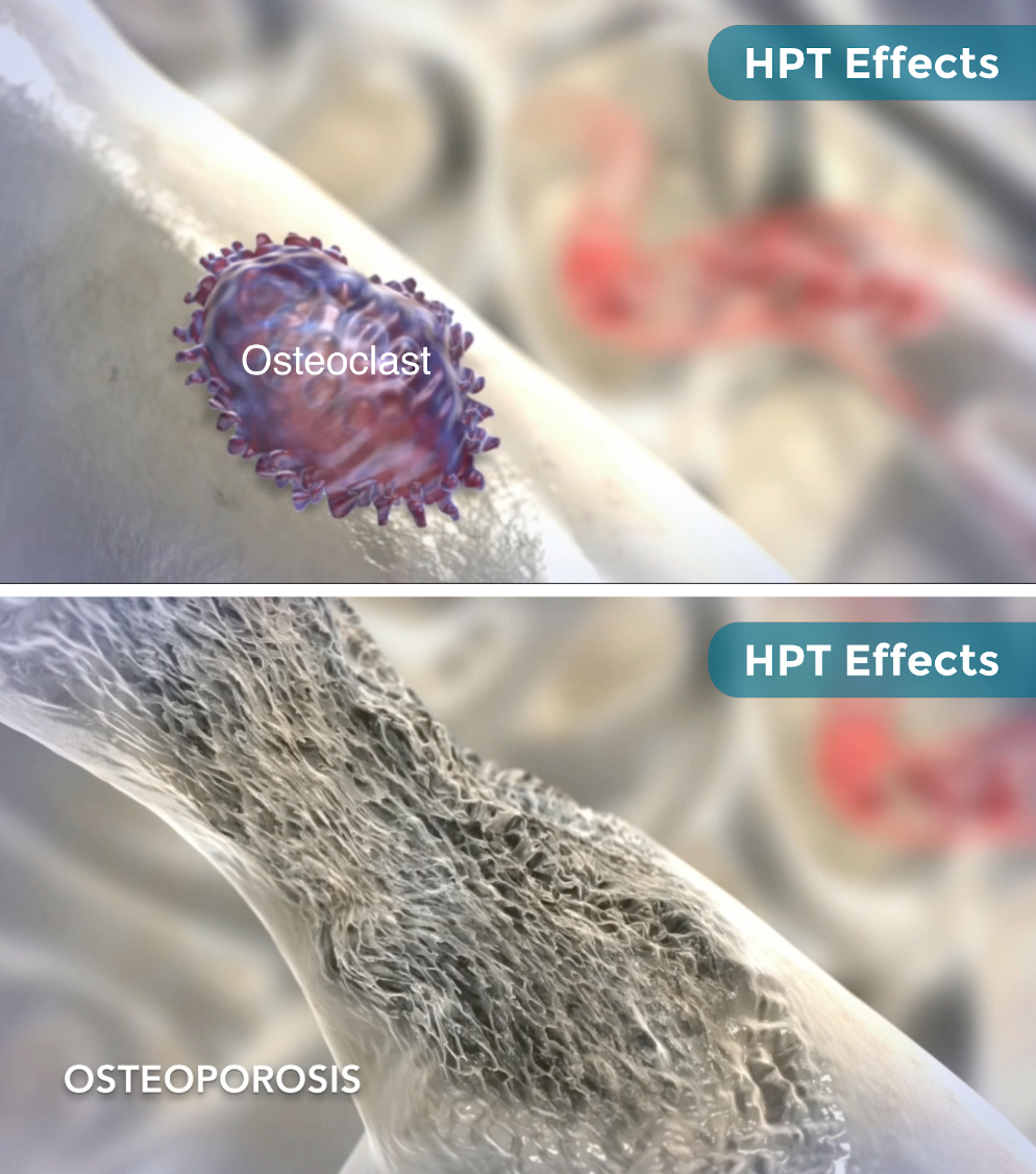  HPT and osteoporosis