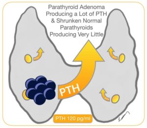 Illustration of a parathyroid adenoma producing high levels of PTH with surrounding shrunken normal parathyroids.