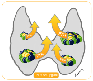 Illustration of an overactive parathyroid condition with elevated PTH levels indicated.