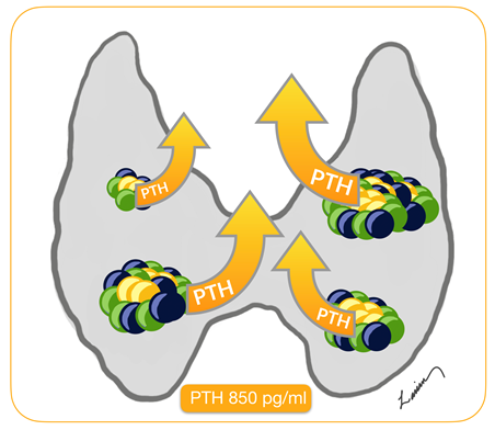 Secondary vs. Tertiary Hyperparathyroidism