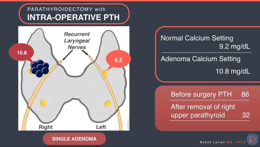 Parathyroidectomy