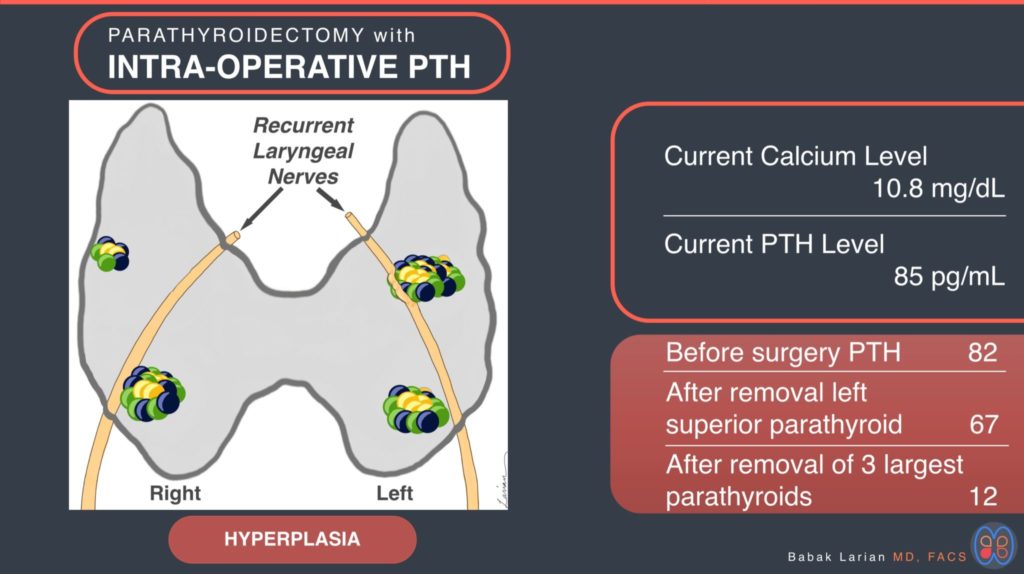 Parathyroidectomy2