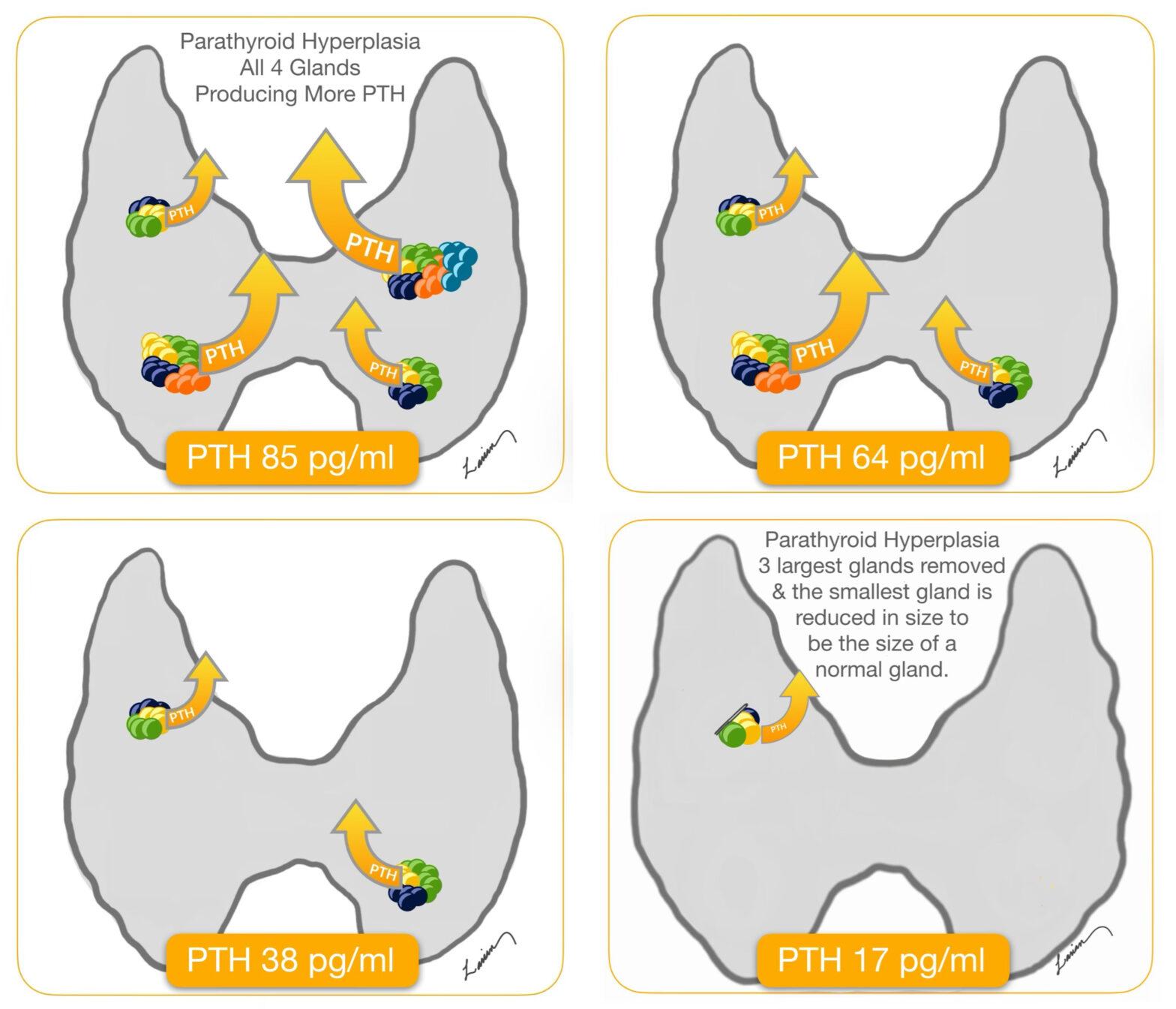 Intraoperative Parathyroid Hormone (PTH) Testing | Dr. Babak Larian