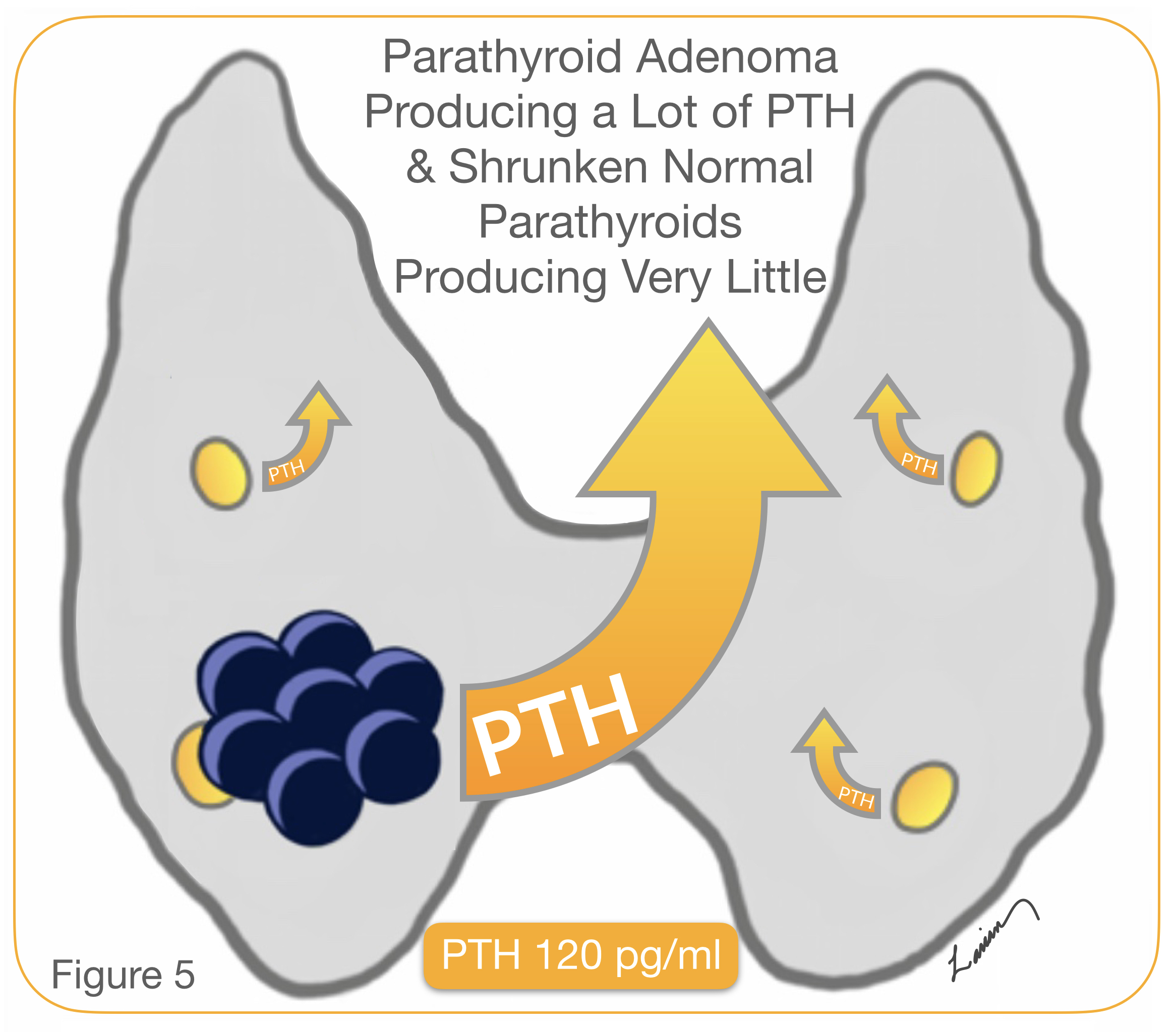 Minimally Invasive Parathyroidectomy✅