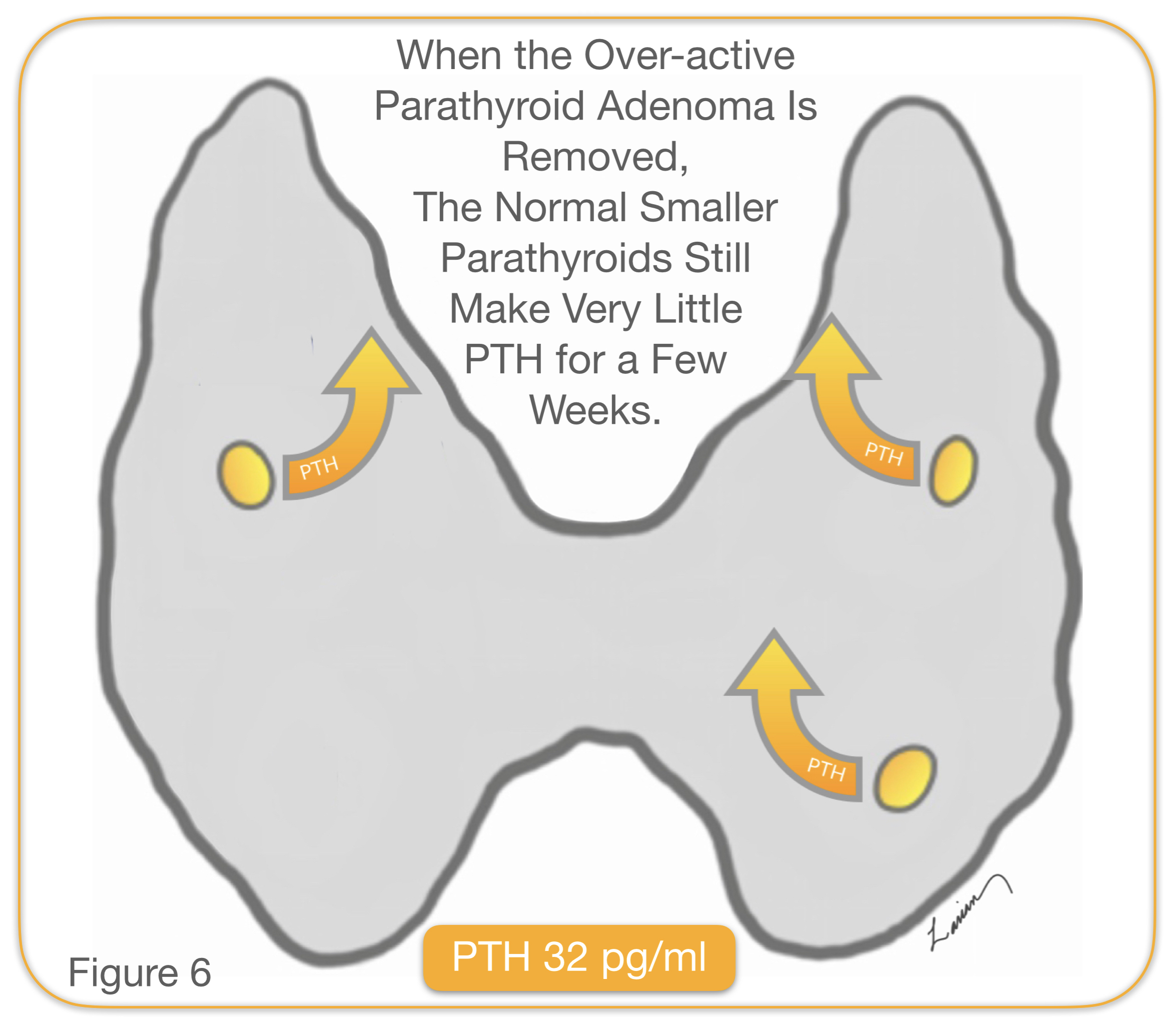 Minimally Invasive Parathyroidectomy✅