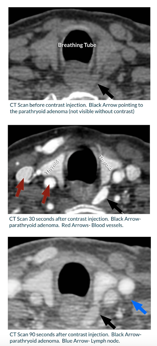4D Parathyroid CT Scan