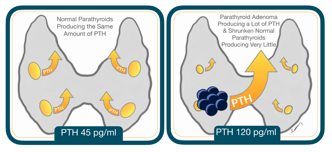  illustration of a healthy parathyroid gland versus one with an adenoma affecting PTH production levels