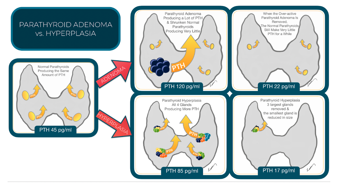 diagram comparing normal parathyroid glands, parathyroid adenoma, and hyperplasia with respective PTH levels and post-surgical state.
