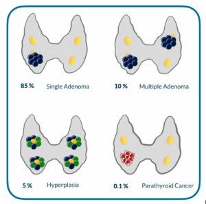 parathyroid adenoma
