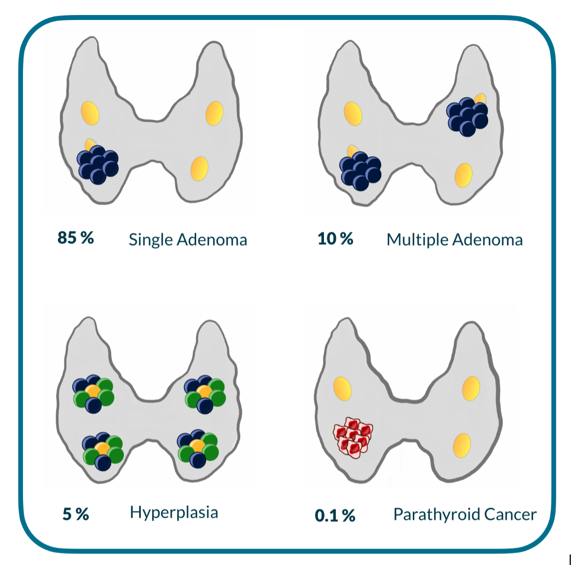 parathyroid adenoma