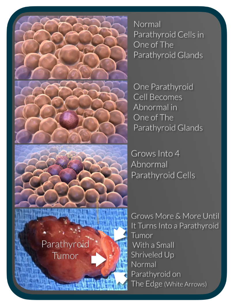 diagram showing the progression of normal parathyroid cells to a parathyroid tumor 