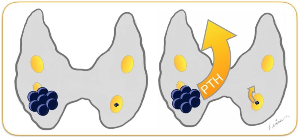 Large-Parathyroid-Adenoma-PTH-1024x496