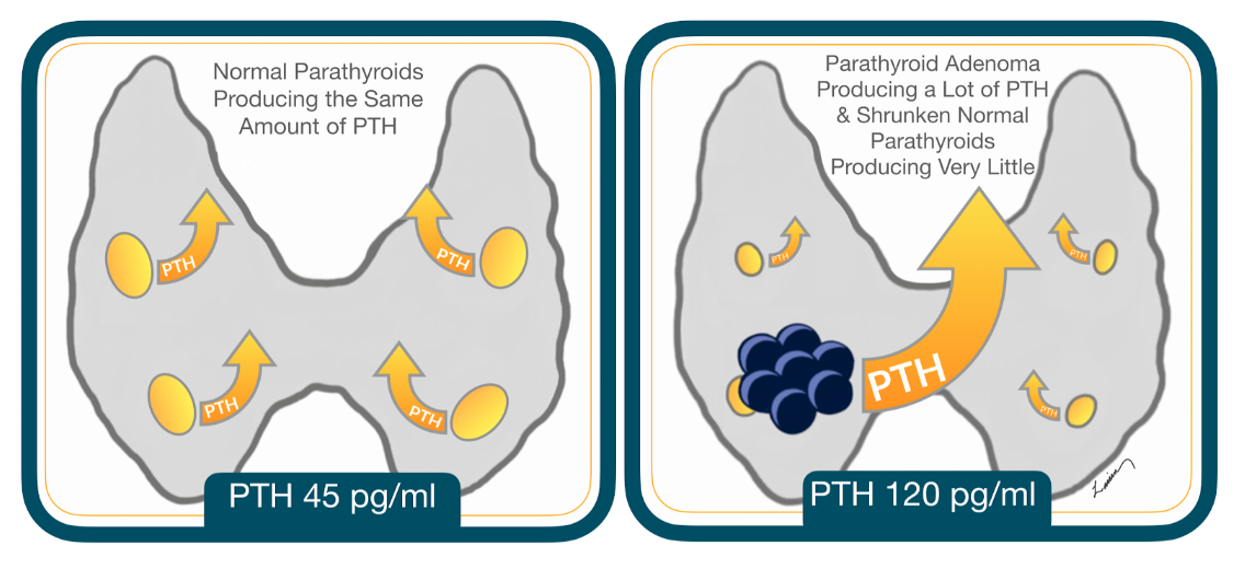 PTH-levels