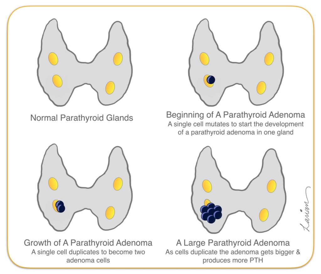 Parathyroid-Adenoma-Growth-1024x872
