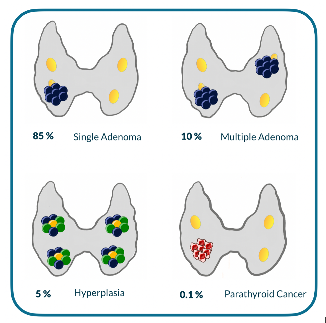 parathyroid-adenoma