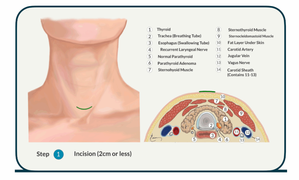 parathyroid-surgery-scar-1024x616
