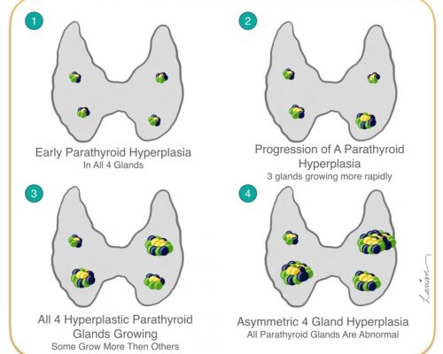 Parathyroid-Hyperplasia-Growth-1024x875